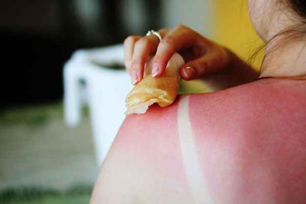 3 Häufige Sonnenbrandmittel Essig, Haferflocken und Backpulver